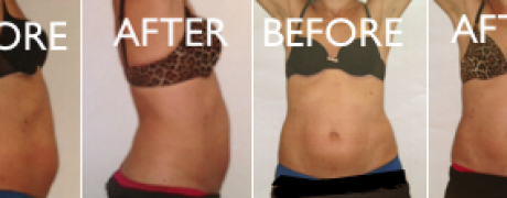 Cool Sculpting Treatment Before and AFter Image Tummy
