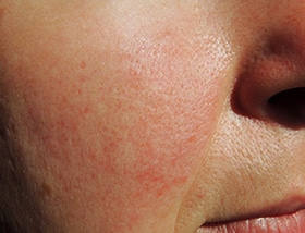 Do you have a permanently red or flushed face It could be Rosacea Sufferer
