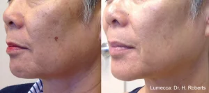 HR Lumecca 1a Before and After Image Face
