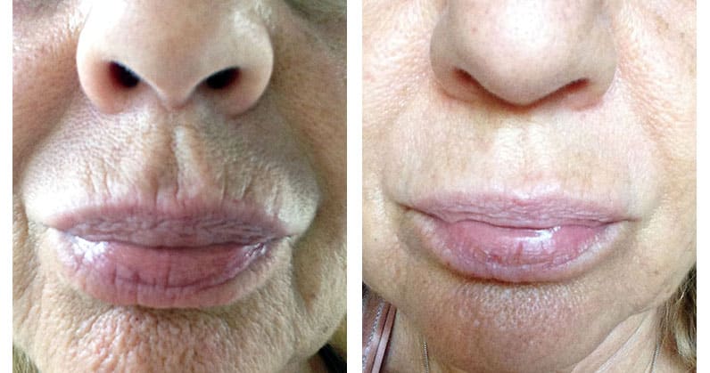 Lip Lines Before and After LightStim