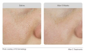 Lumixa Collagen Booster 01 Before and After Image Photo Courtesy of FB Dermatology