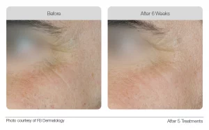 Lumixa Collagen Booster 02 Before and After Image Photo Courtesy of FB Dermatology