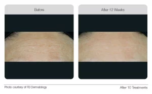 Lumixa Collagen Booster 03 Before and After Image Photo Courtesy of FB Dermatology