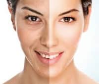 Microdermabrasion Before and After One Treatment - Microdermabrasion Comparison