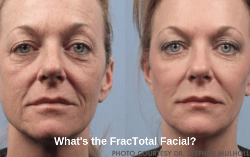 What’s the FracTotal Facial and Why Do We Want It - FracTotal Facial Featured Image