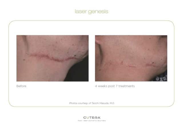 laser-genesis-ba12 - Laser Genesis Before and Post Treatment Image Cutera 4 Weeks 7 treatments