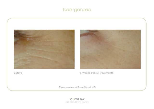 laser-genesis-ba21 - Laser Genesis Before and Post Treatment Image Cutera 3 treatments