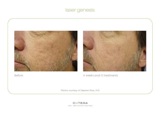 laser-genesis-ba23v- Laser Genesis Before and Post Treatment Image Cutera 4 Weeks