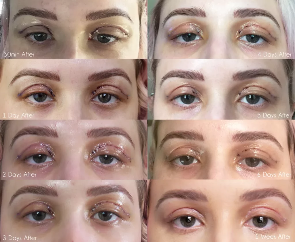 Blepharoplasty Patient Amea May talks to us about her Eyelid Lift Progress - the_first_week1